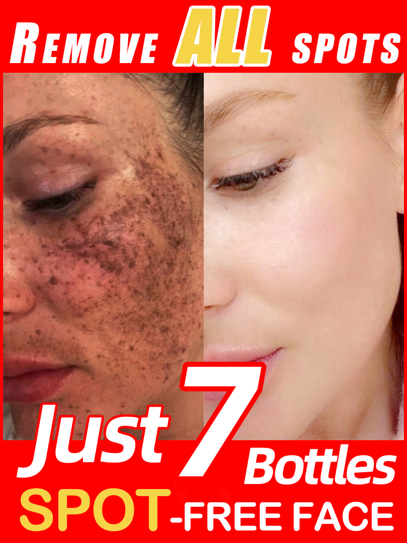Çilleri, Melazmayı ve Yüzdeki  - Skincare Luxury Whitening incelemesi ve fiyatı